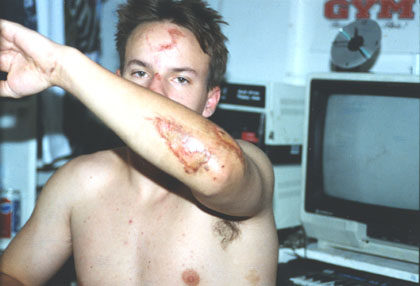 Me after my BMX accident