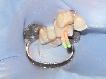 Root canal zoomed in